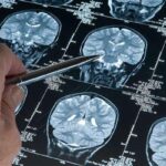 Erkeklerde gizli tehlike! Alzheimer araştırmalarında, demans riskini artıran genetik varyant bulundu: Bu varyanta sahip erkeklerde gelişme riski 2,39